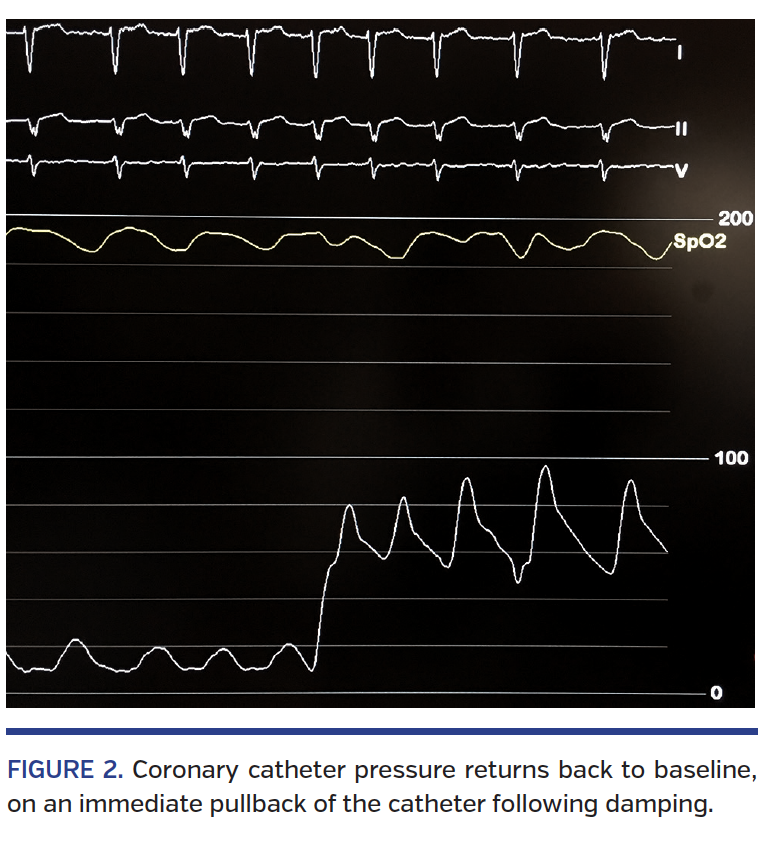 Damped and Ventricularized Coronary Pressure Waveforms